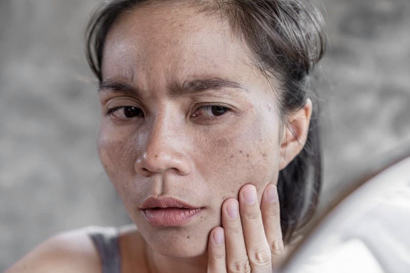 Nám chân đinh là gì? Nguyên nhân, cách trị tận gốc