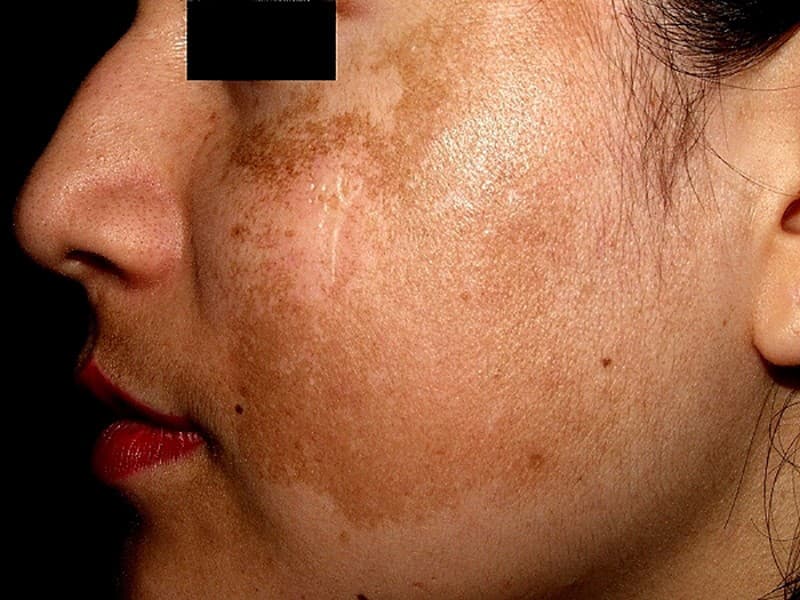 Nám mảng là gì? Hướng dẫn 4+ cách điều trị nám mảng hiệu quả