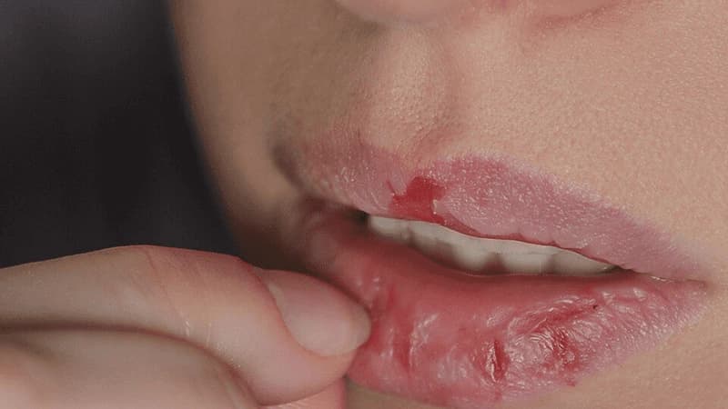 Để môi bong tự nhiên, tránh dùng tay gỡ lớp da vì có thể làm tổn thương