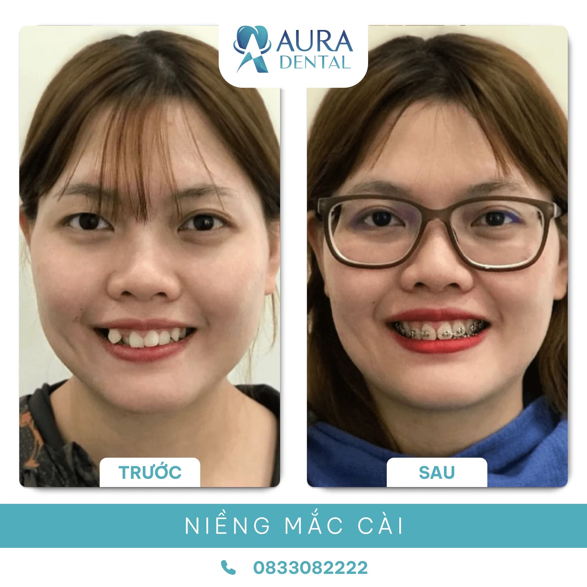 Niềng răng mắc cài