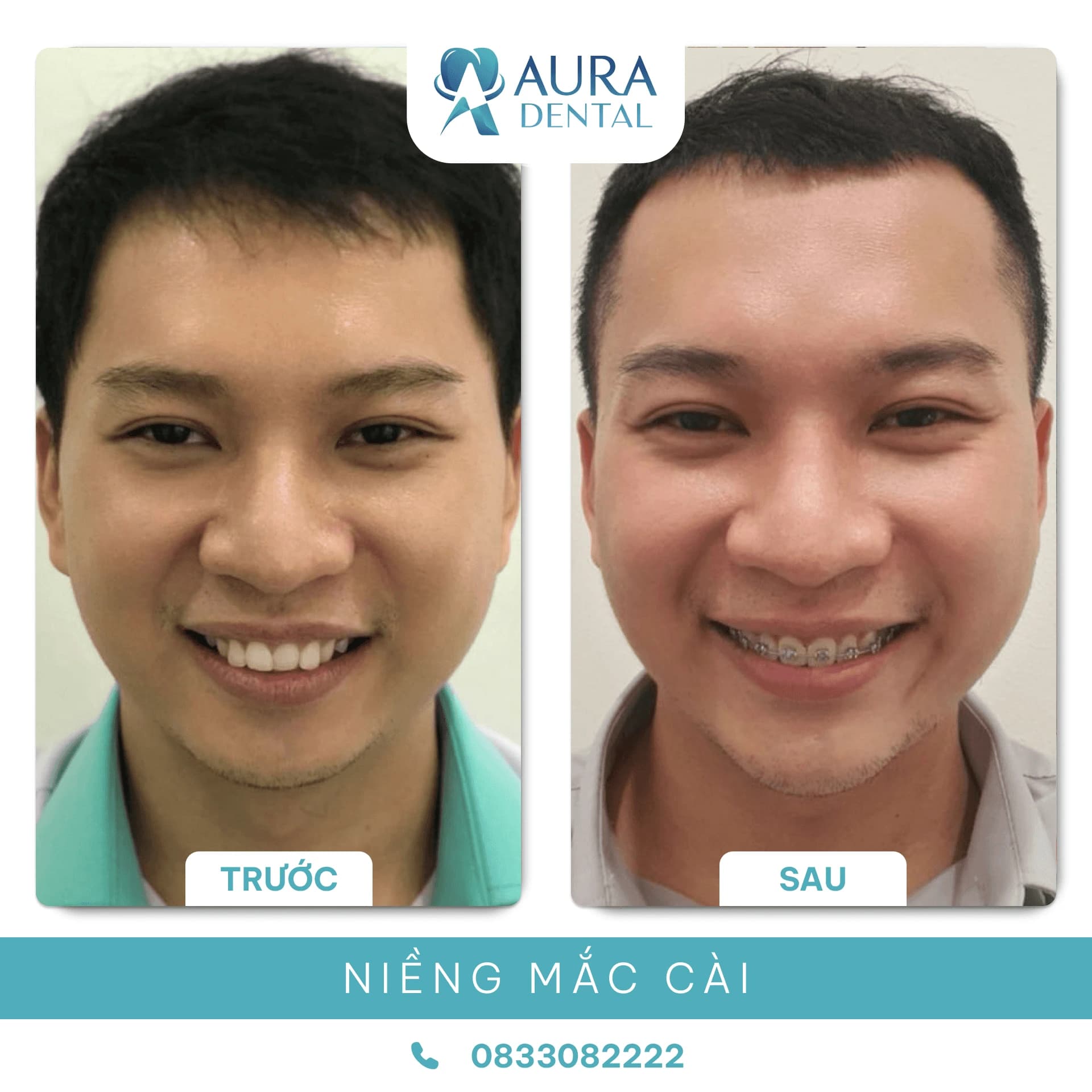 Niềng răng mắc cài