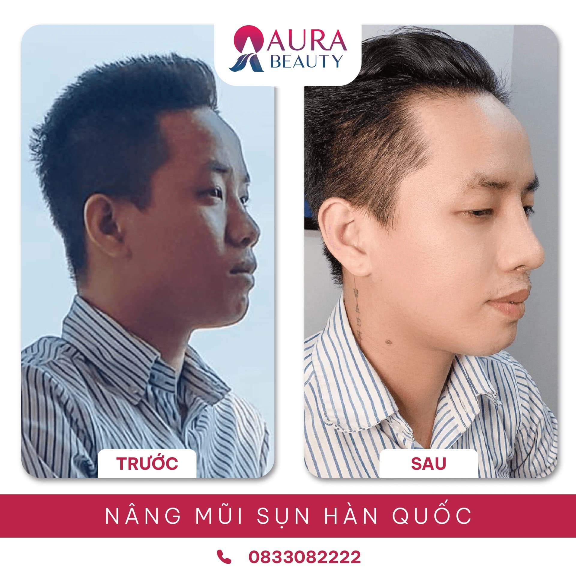 Nâng mũi sụn