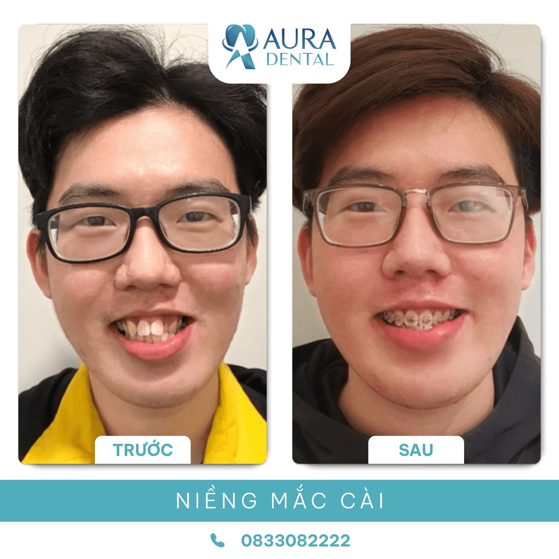 Niềng răng mắc cài
