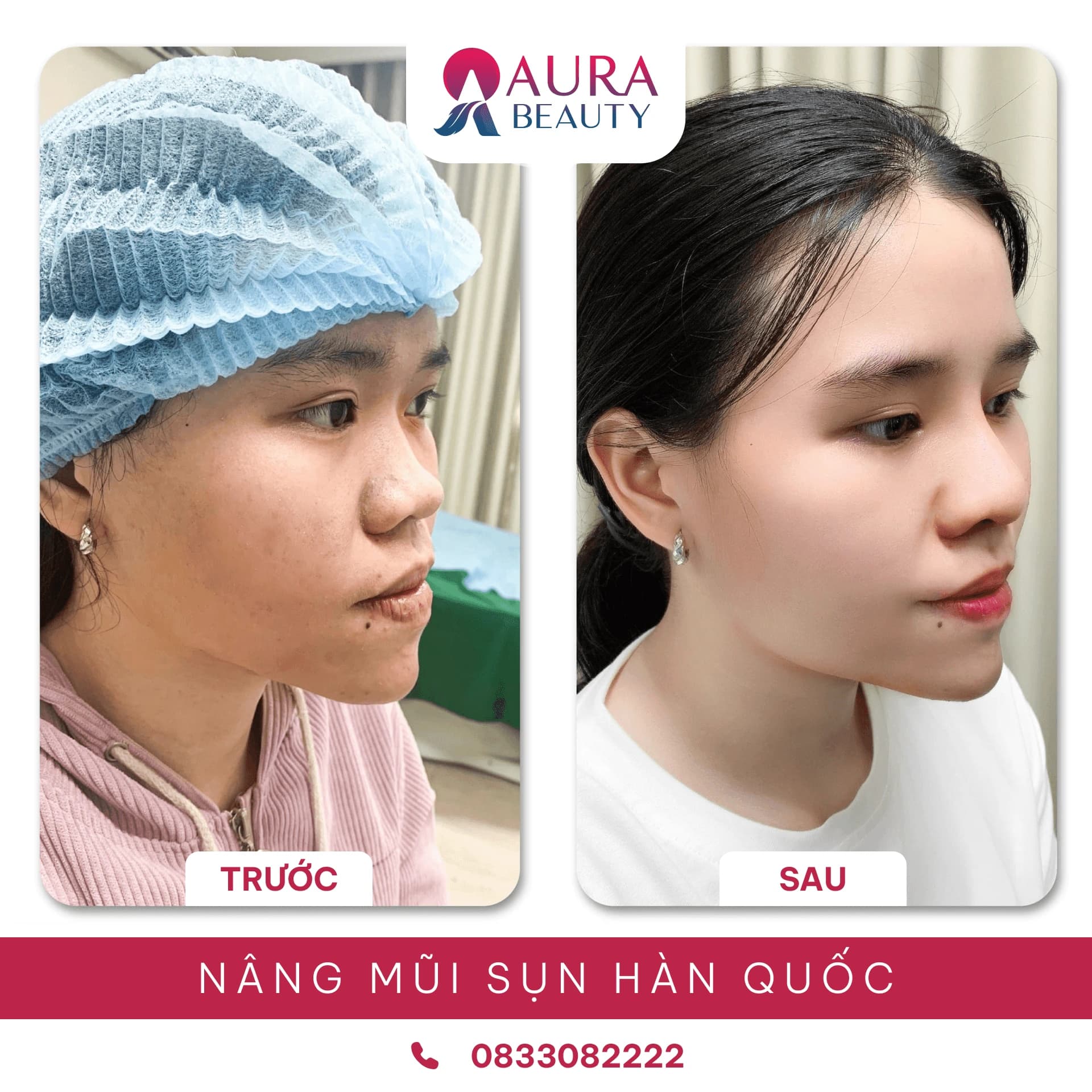 Nâng mũi sụn