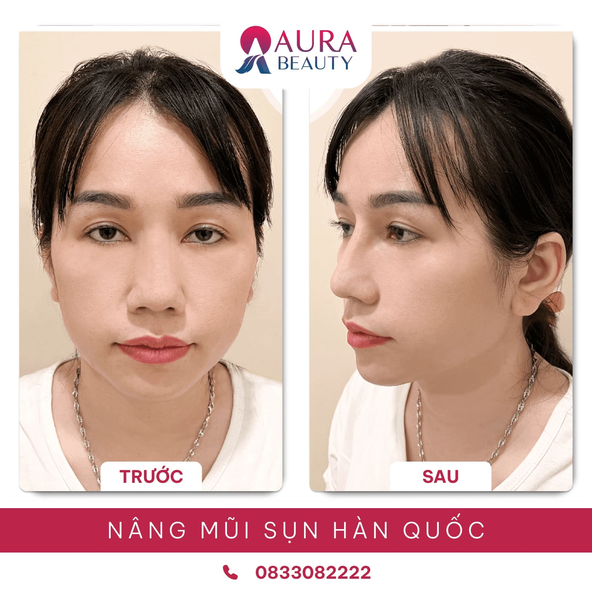 Nâng mũi sụn