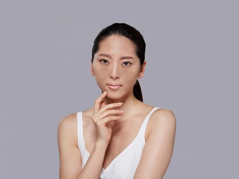 Bật mí các cách trị nám da mặt lâu năm có thể bạn chưa biết