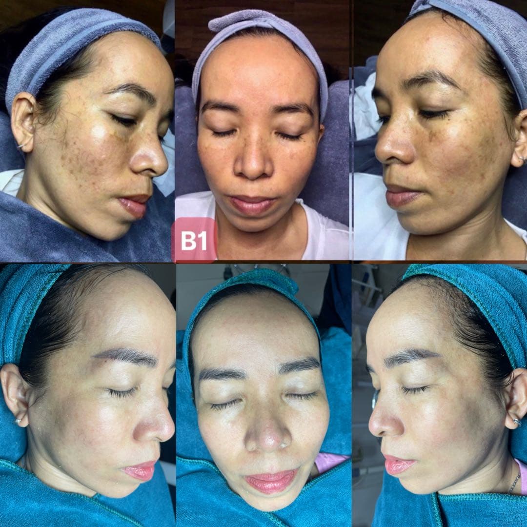 Trước và sau khi điều trị nám chân sâu tại Aura