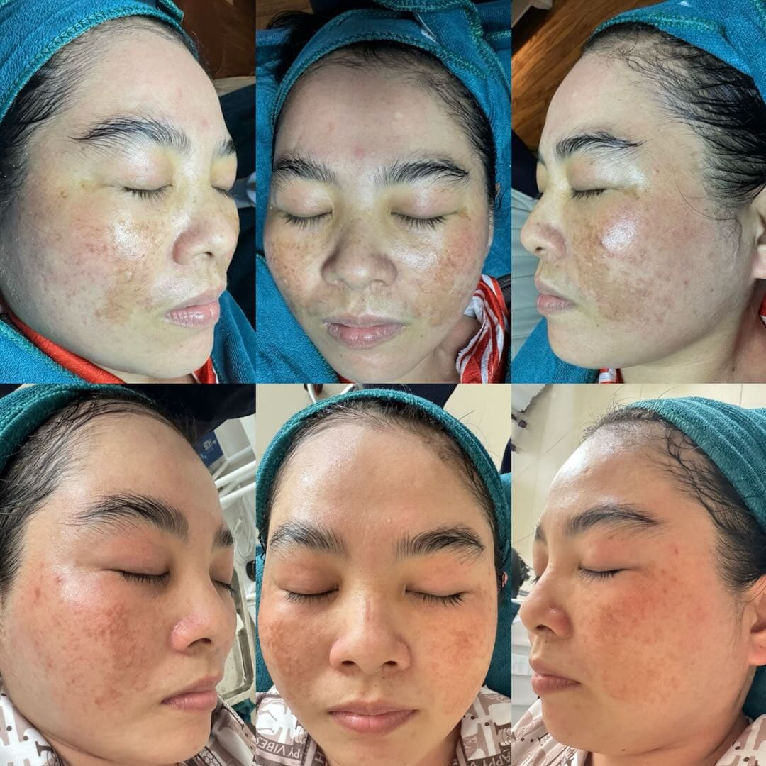 Trước và sau khi điều trị nám hỗn hợp tại Aura