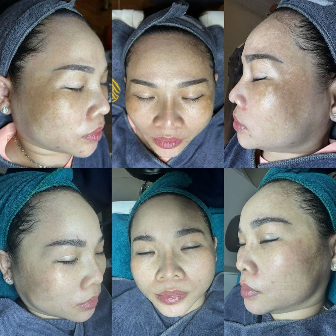 Trước và sau khi điều trị nám mảng hai bên má tại Aura
