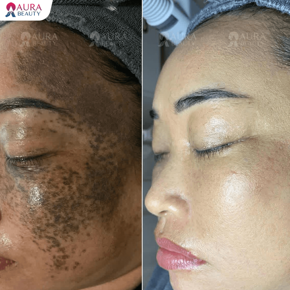 Trước và sau khi điều trị nám mảng vùng má tại Aura