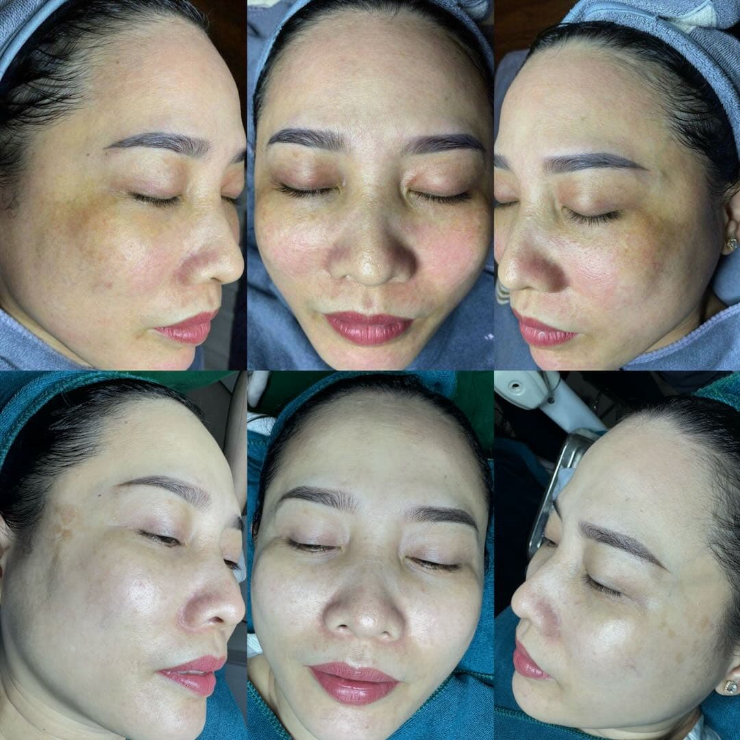 Trước và sau khi điều trị nám sau sinh tại Aura