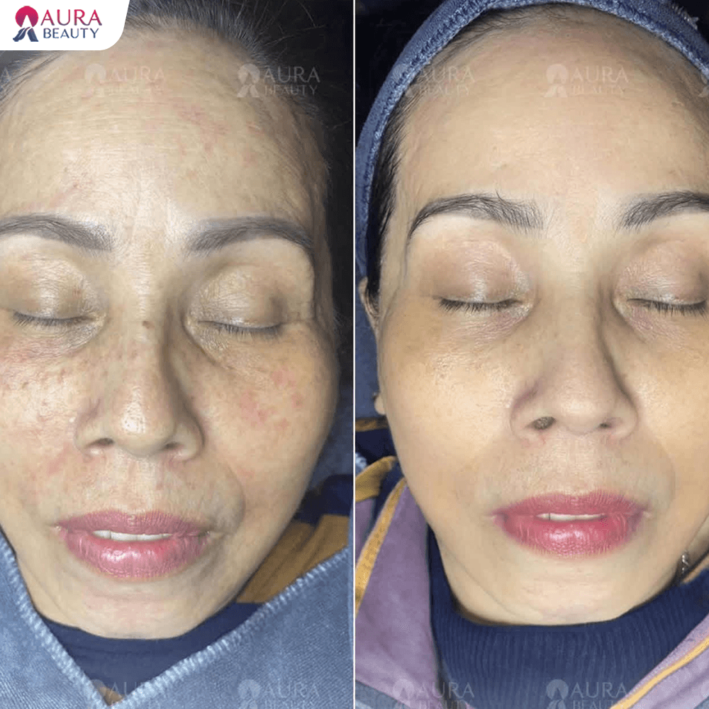 Trước và sau khi điều trị nám sau sinh tại Aura