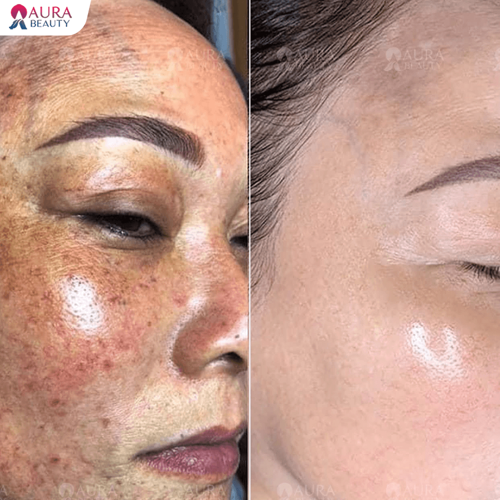 Trước và sau khi điều trị tàn nhang lâu năm tại Aura