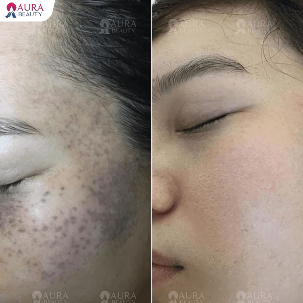 Trước và sau khi điều trị tàn nhang và đốm nâu tại Aura