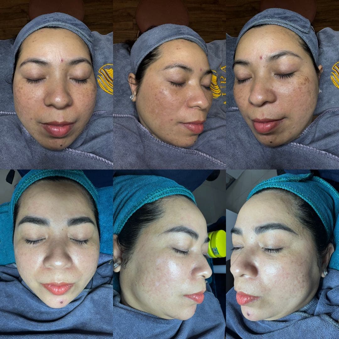 Trước và sau khi điều trị tàn nhang và đốm nâu tại Aura