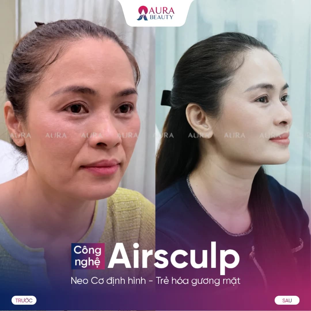 Kết quả trước và sau Airsculpt của khách hàng 1