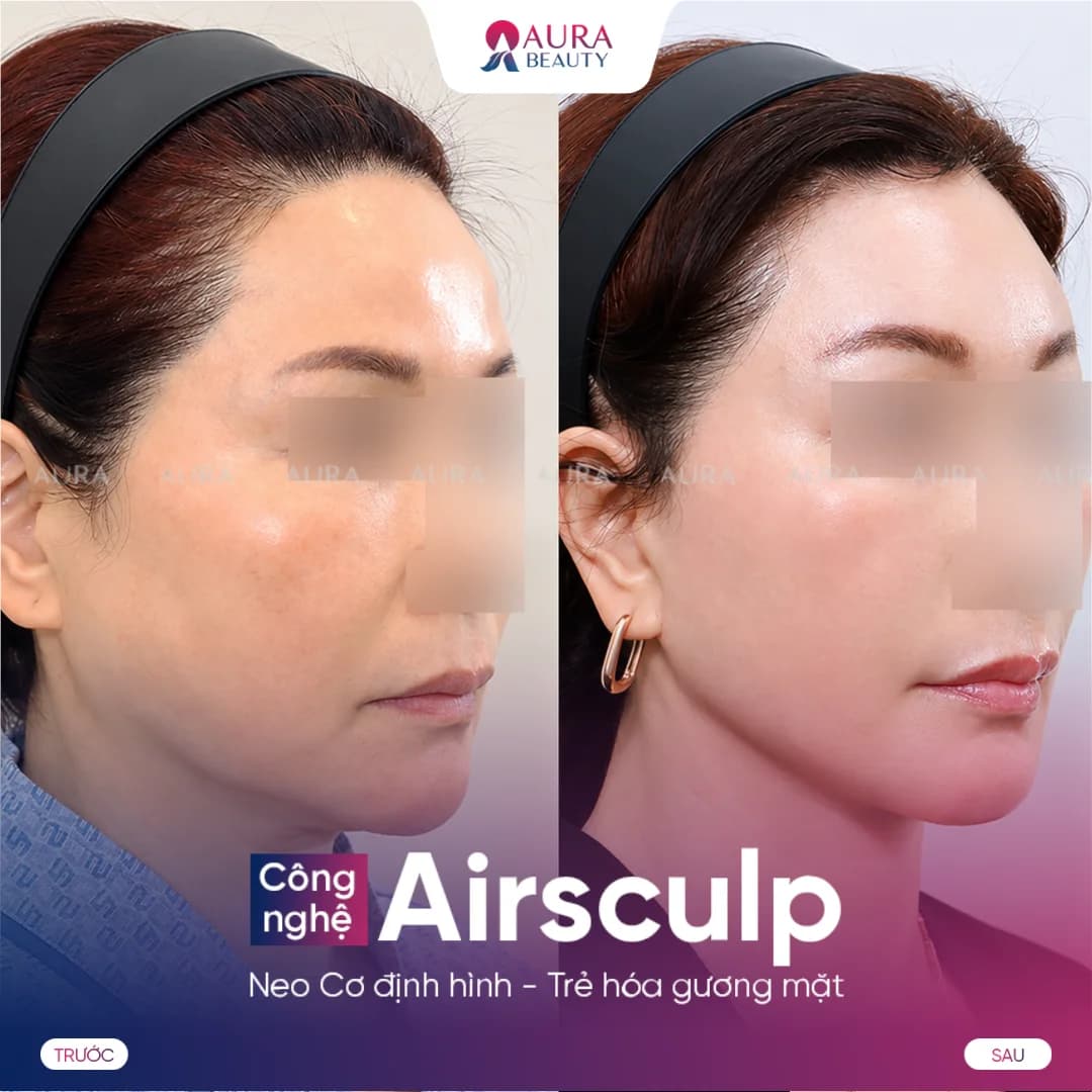 Kết quả trước và sau Airsculpt của khách hàng 2