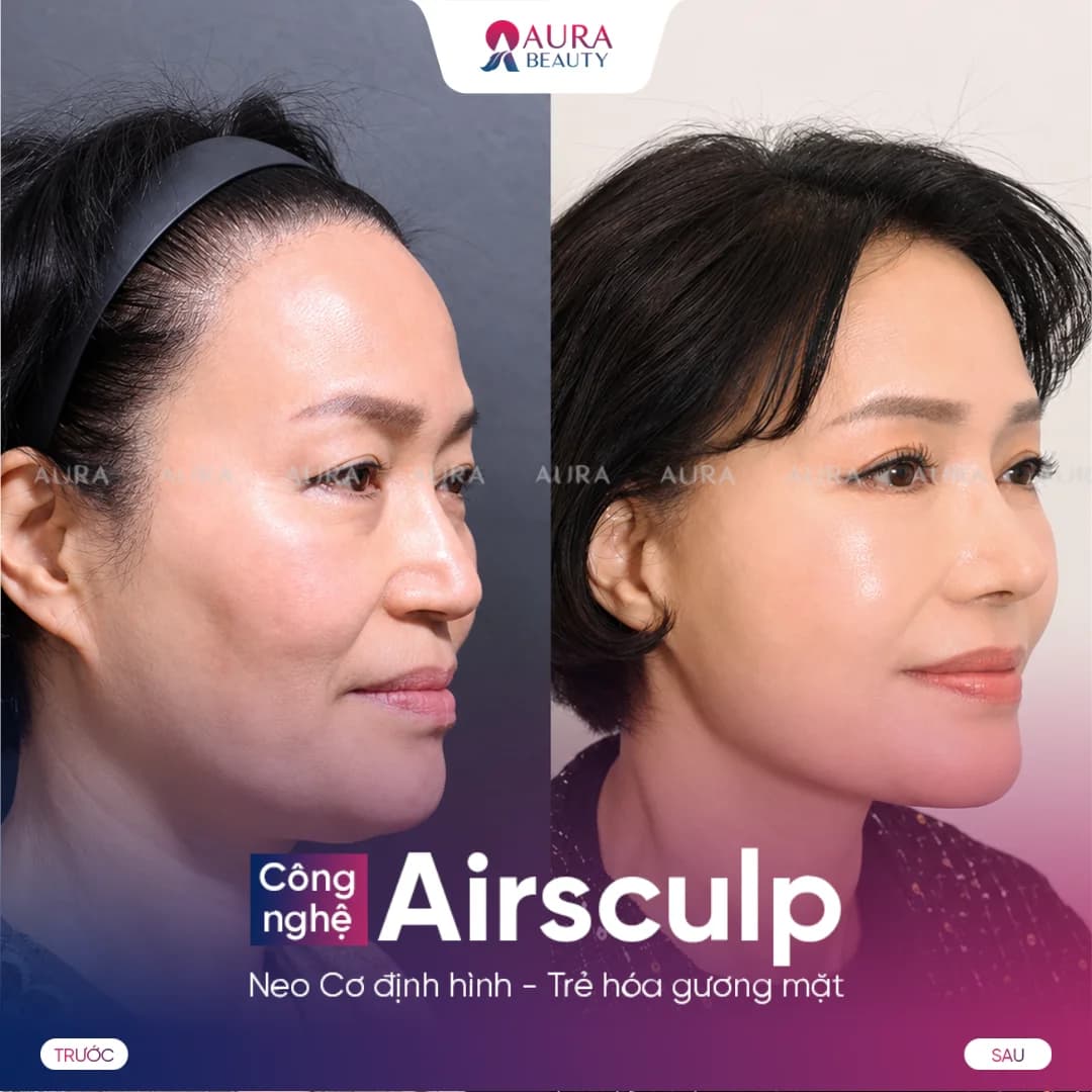 Kết quả trước và sau Airsculpt của khách hàng 3