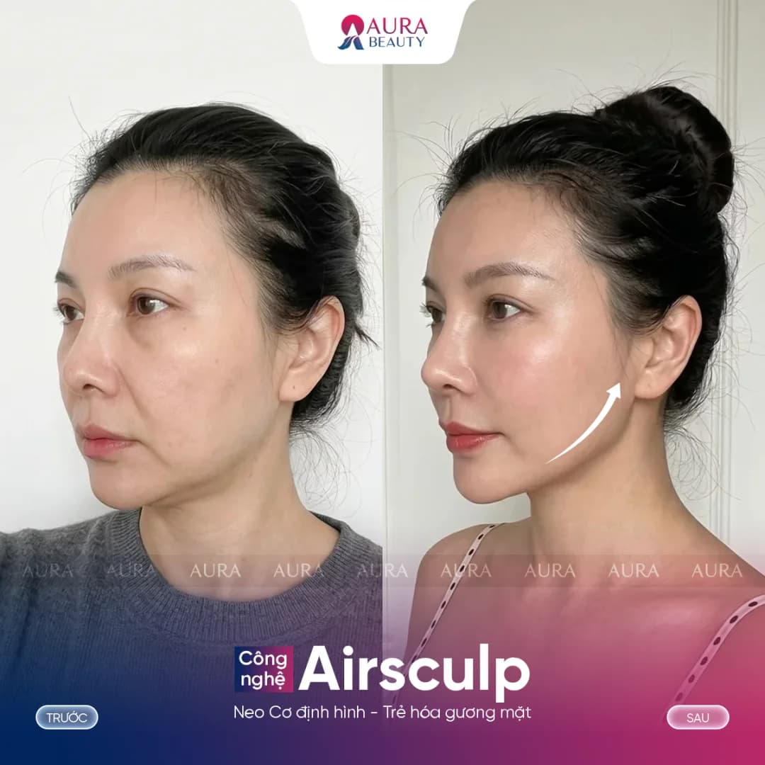 Kết quả trước và sau Airsculpt của khách hàng 4