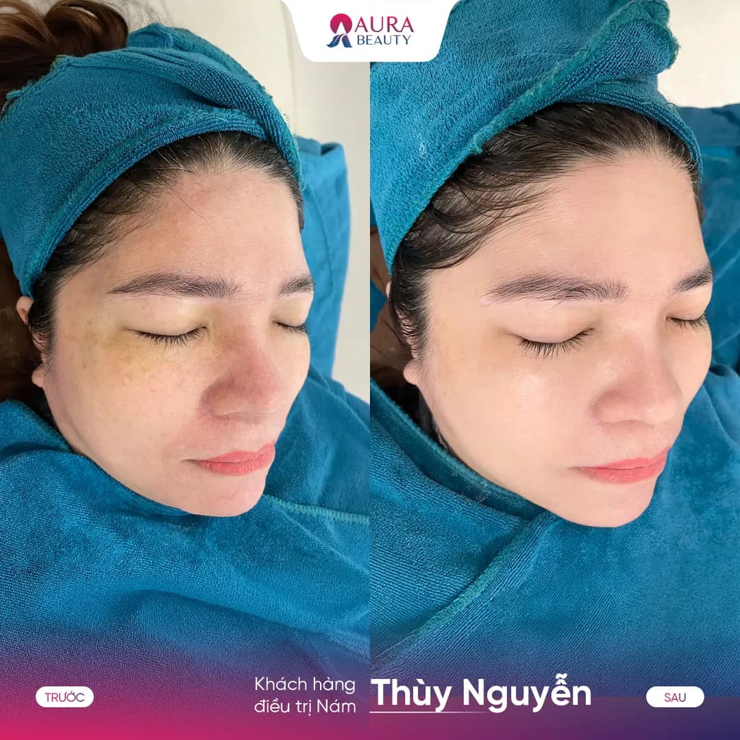 Trước và sau liệu trình SkinGold Melasma của khách hàng Thùy Nguyễn