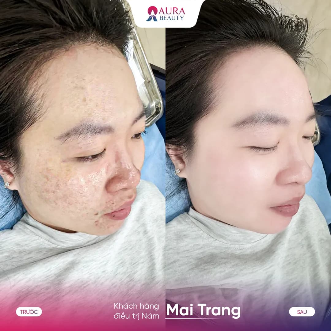 Trước và sau liệu trình SkinGold Melasma của khách hàng Mai Trang