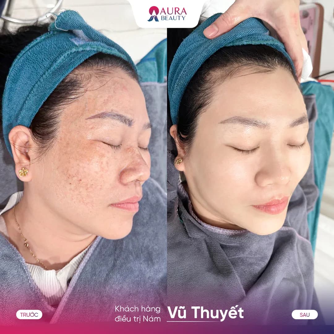 Trước và sau liệu trình SkinGold Melasma của khách hàng Vũ Thuyết
