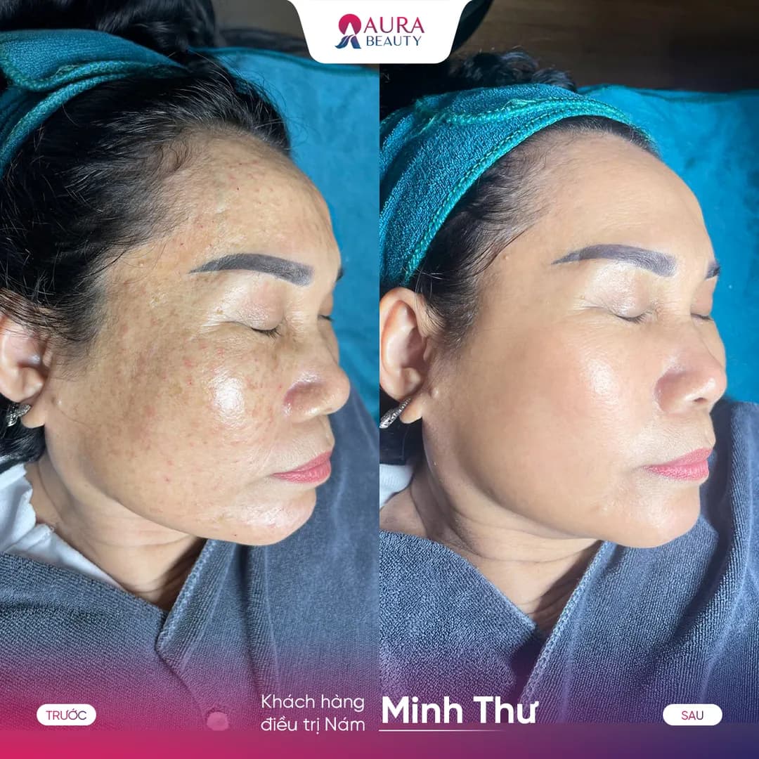 Trước và sau liệu trình SkinGold Melasma của khách hàng Minh Thư