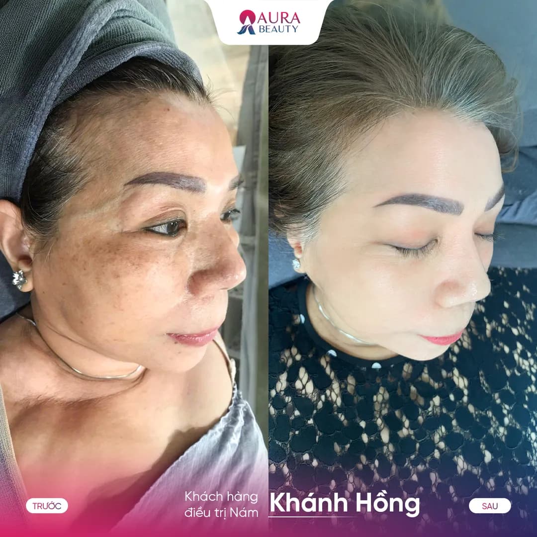 Trước và sau liệu trình SkinGold Melasma của khách hàng Khánh Hồng
