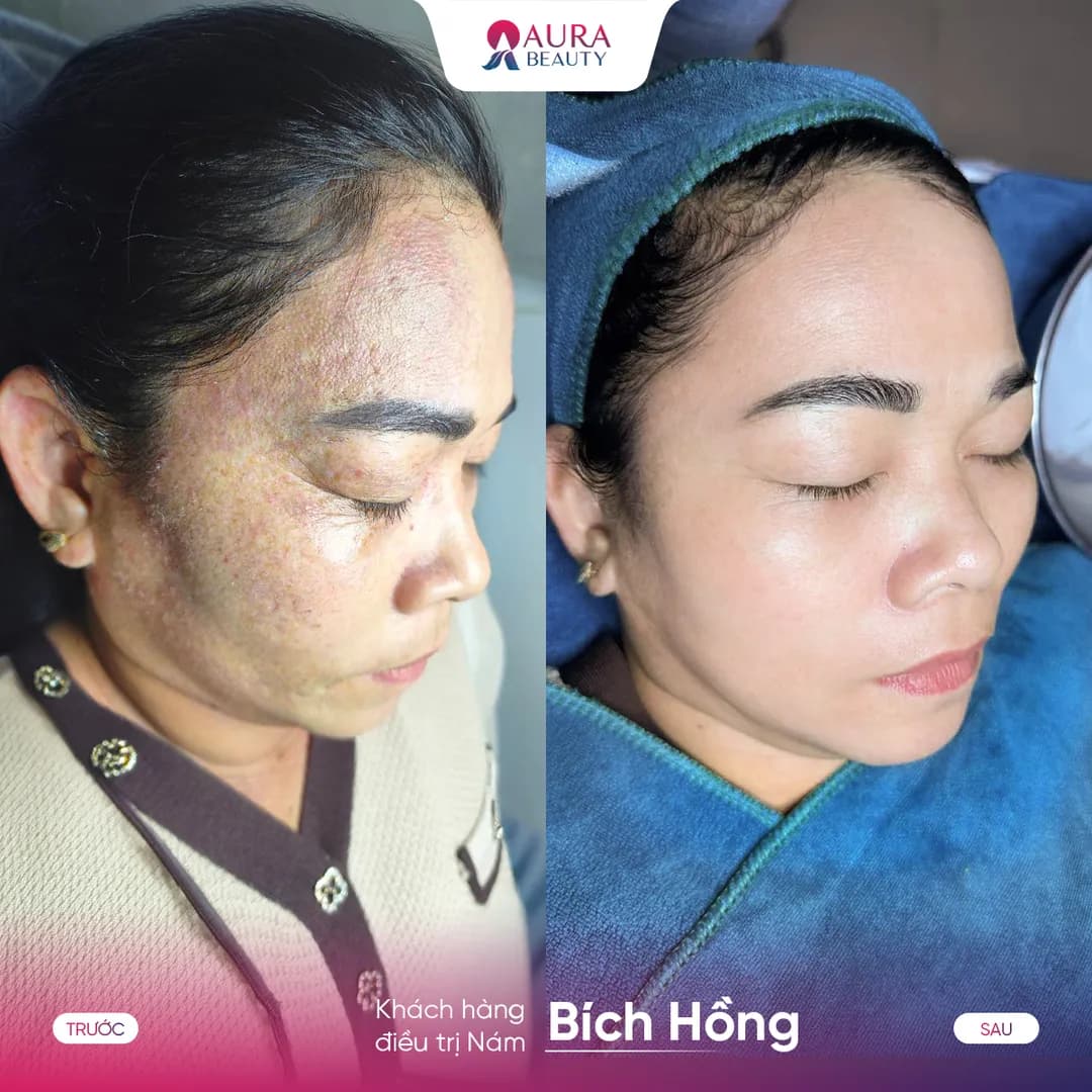 Trước và sau liệu trình SkinGold Melasma của khách hàng Bích Hồng
