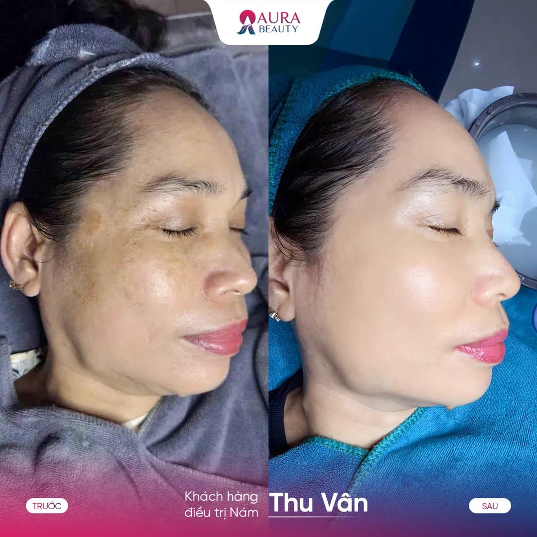 Trước và sau liệu trình SkinGold Melasma của khách hàng Thu Vân