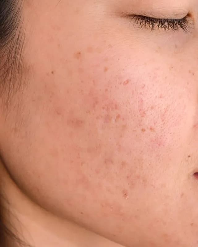 Cận cảnh vùng da có biểu hiện đốm nâu