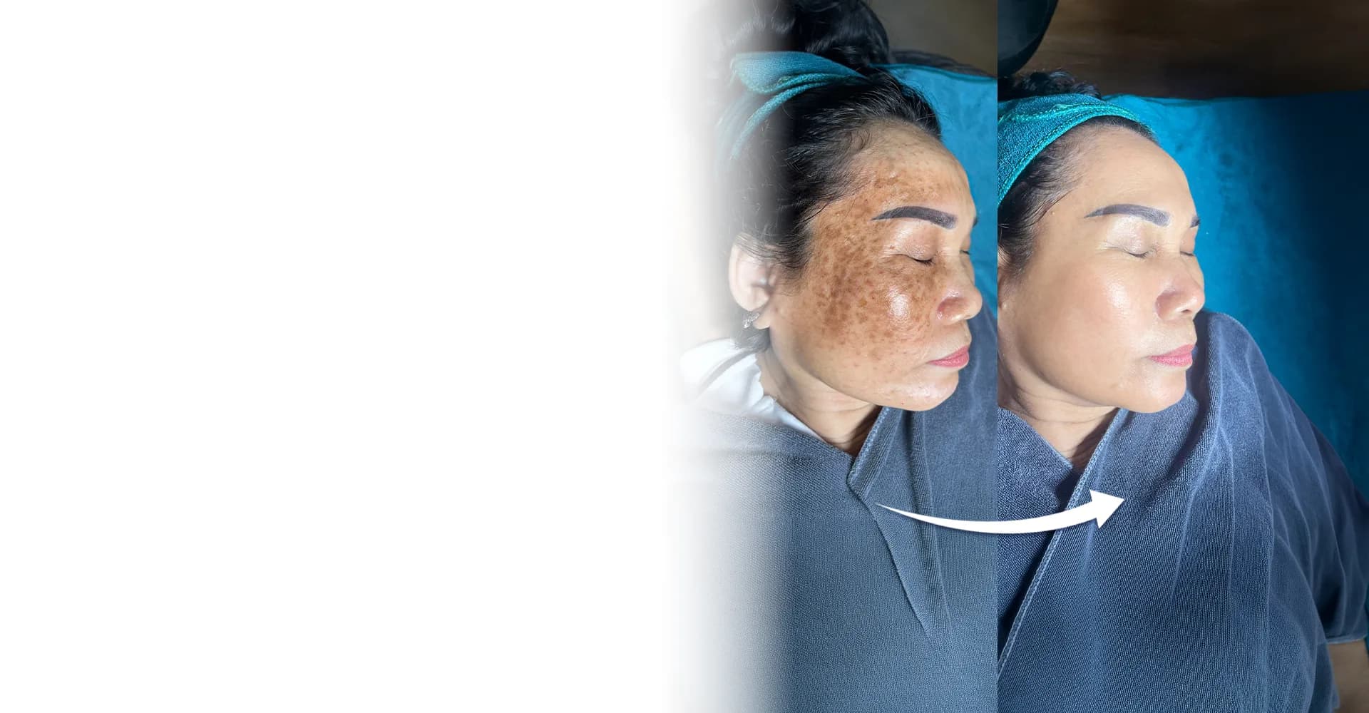 Khách hàng trước và sau liệu trình SkinGold Melasma: vùng nám sạm trên má được cải thiện rõ