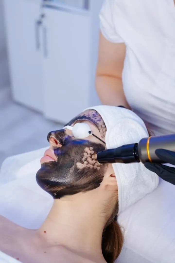 Thực hiện siêu vi điểm sắc tố tại vùng da cần chăm sóc