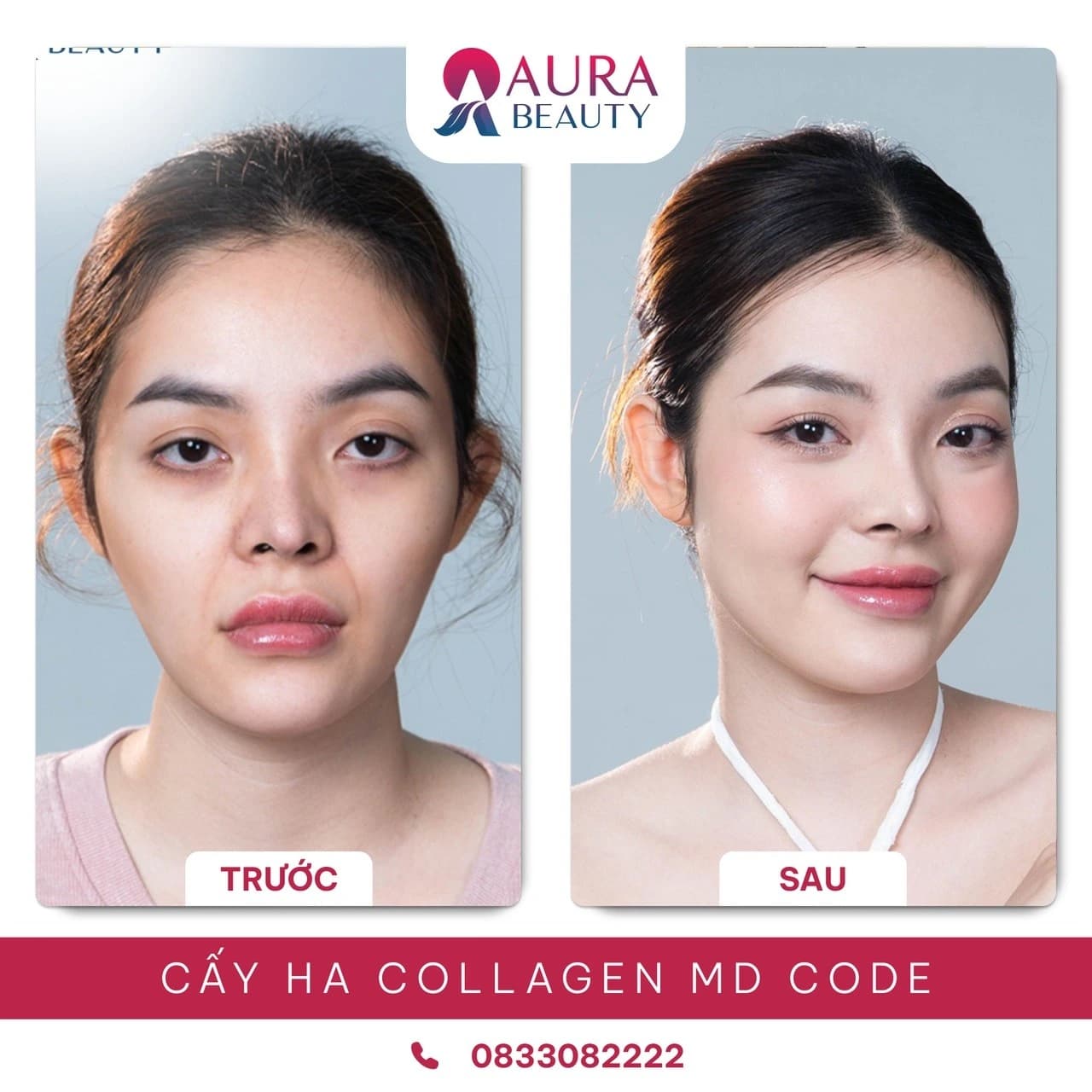 Hình ảnh khách hàng trước và sau khi sử dụng dịch vụ MD Code làm đầy má hóp tại thẩm mỹ Aura