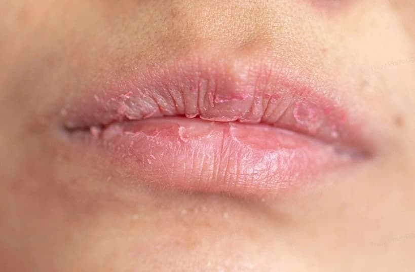 Môi khô, nứt nẻ chính là nguyên nhân khiến phun môi 3 ngày đã bong vảy