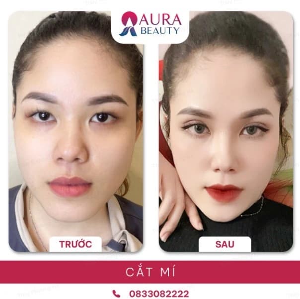Phẫu thuật nhấn mí tại Thẩm mỹ viện Quốc Tế Aura
