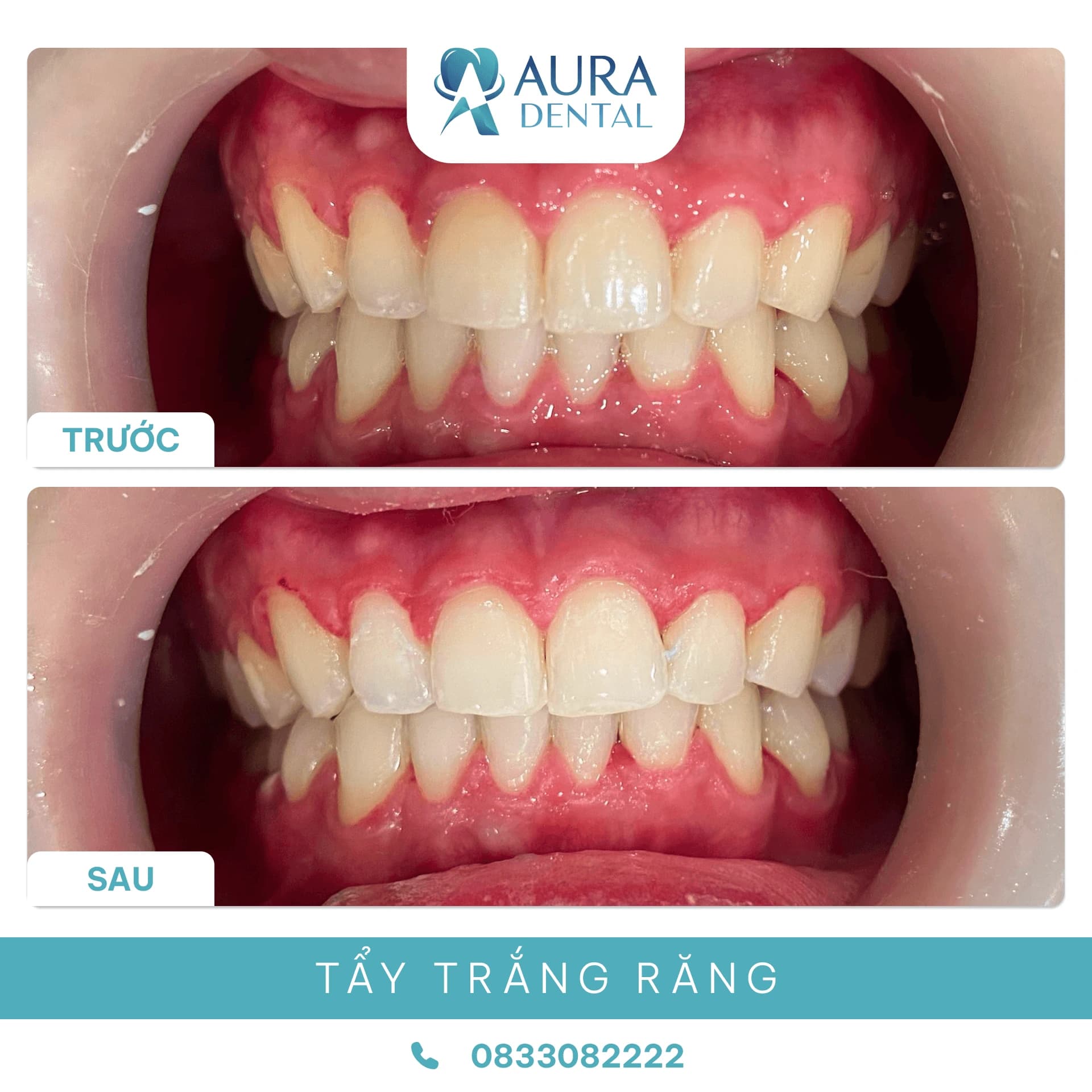 Tẩy trắng răng
