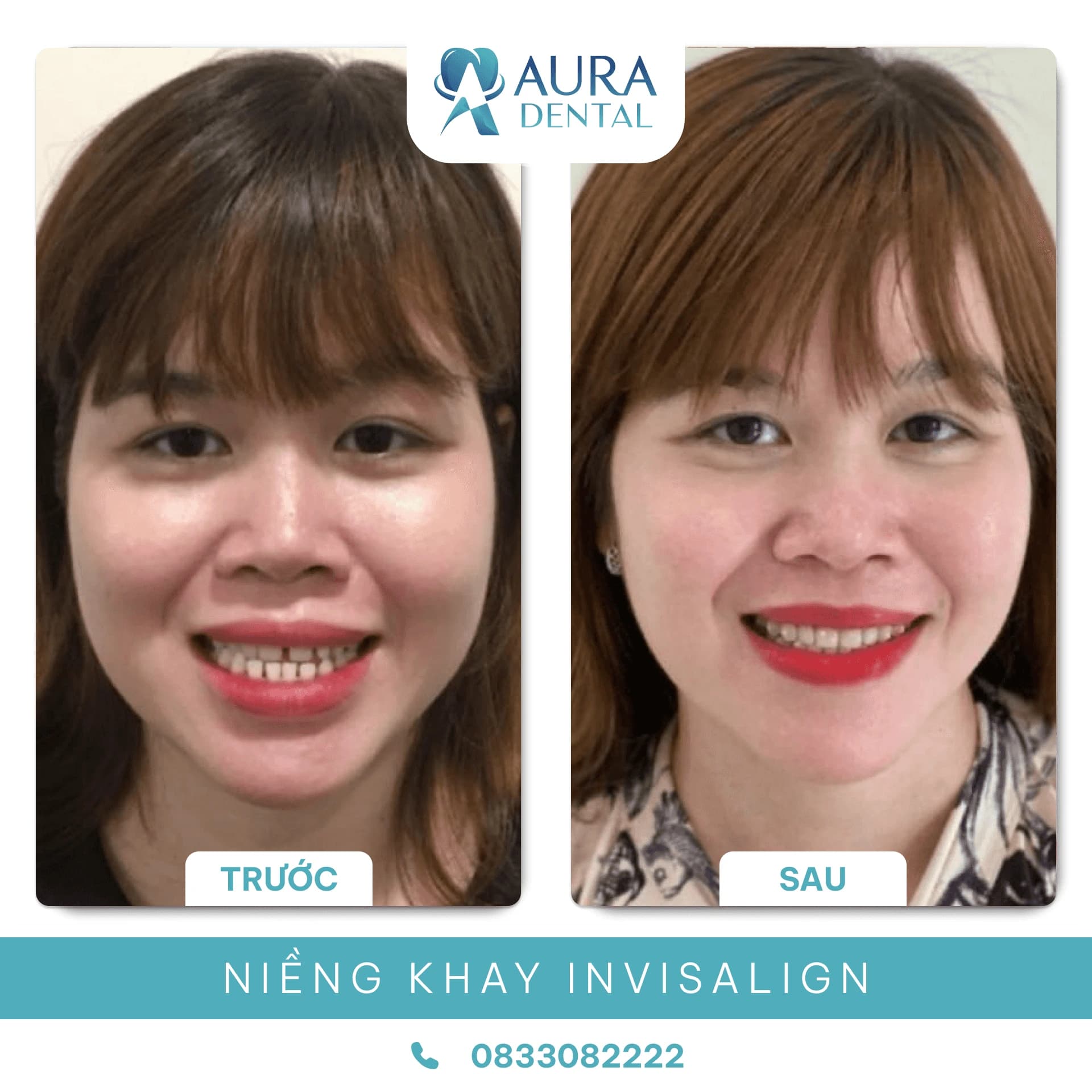 Niềng Răng Trong Suốt
