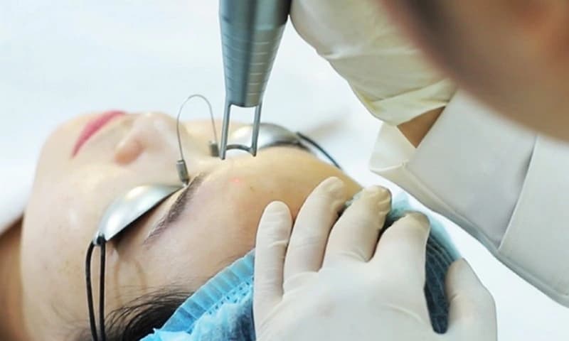 Loại bỏ nám bằng công nghệ Laser Q-switched Nd:YAG