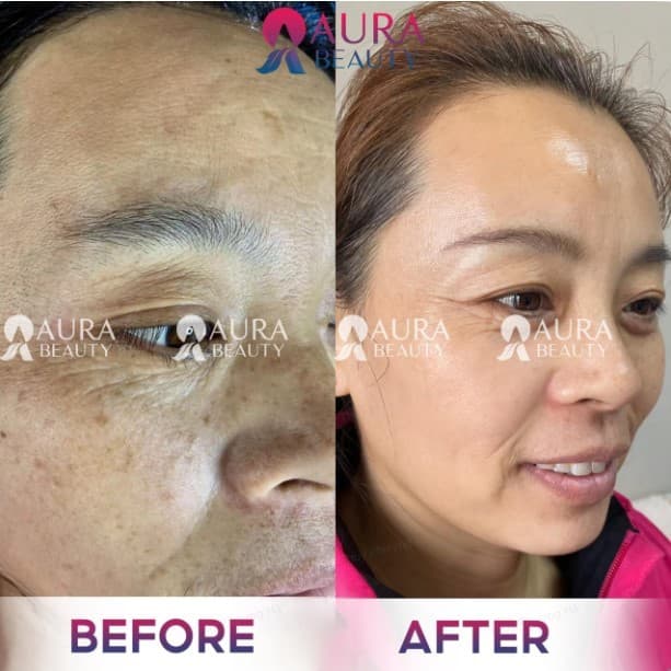 Feedback khách hàng sau khi trị nám tại Aura