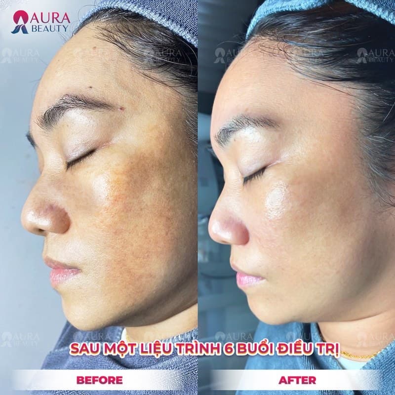 Khách hàng trị nám tại Aura