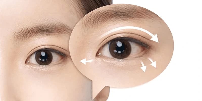 Chi phí cắt mí thường dao động từ 10 đến 30 triệu đồng
