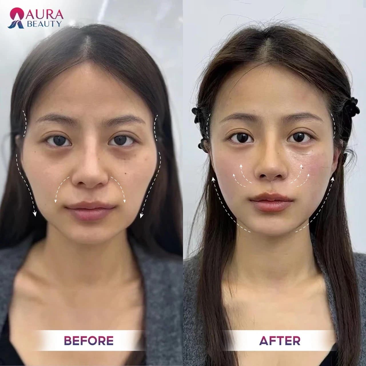 Cấy HA collagen giúp gương mặt đầy đặn, tươi trẻ hơn