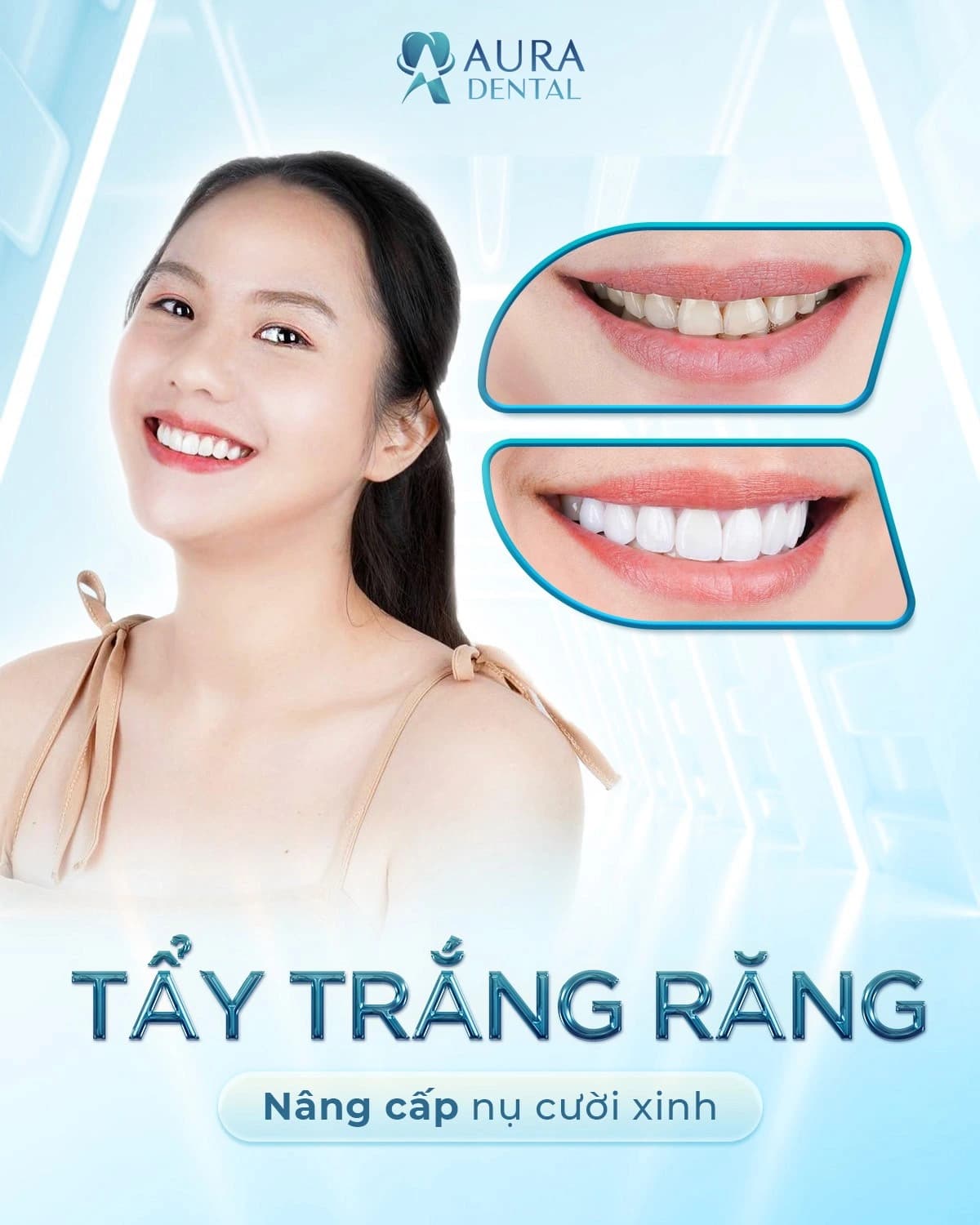 Tẩy trắng răng