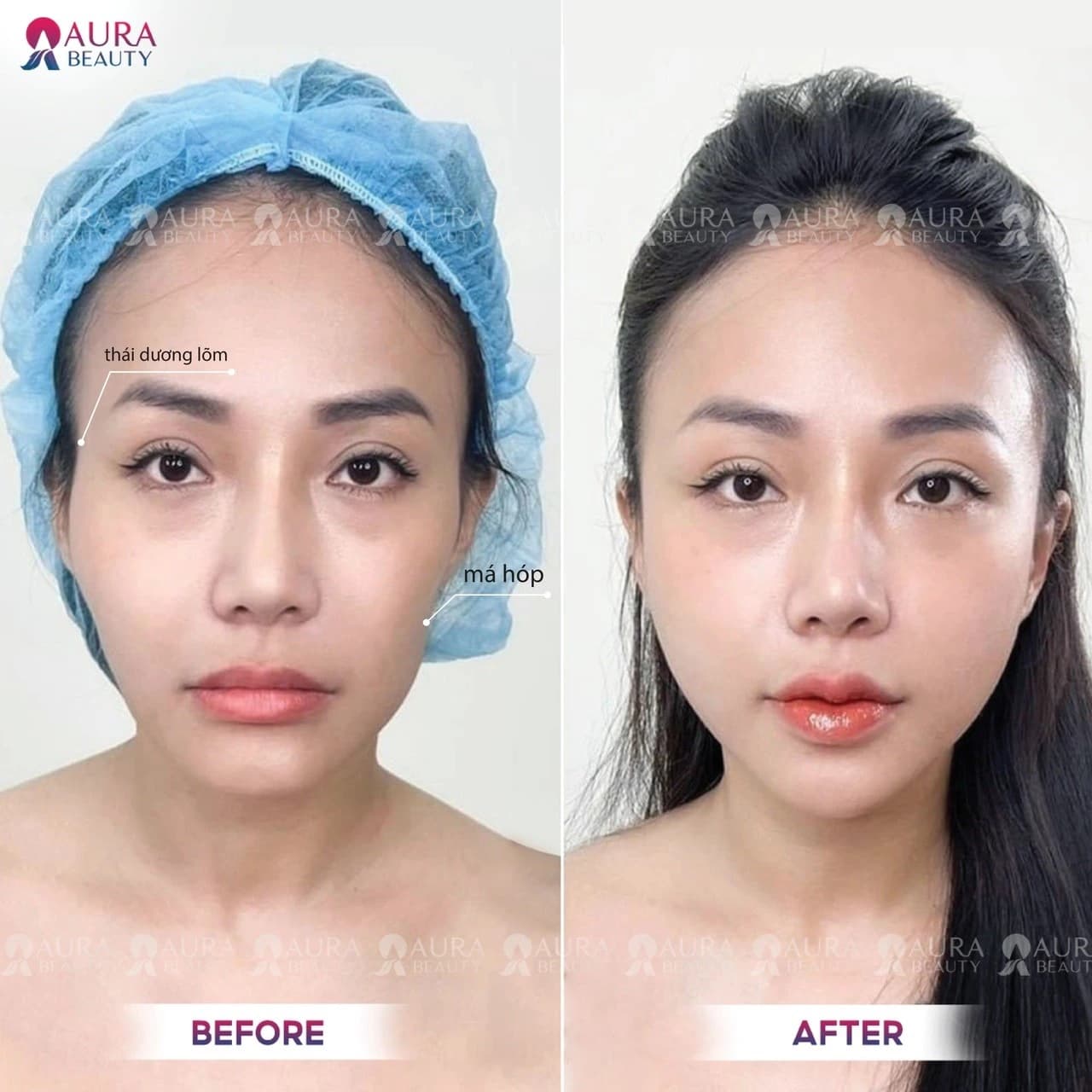 Cấy HA Collagen làm đầy má hóp