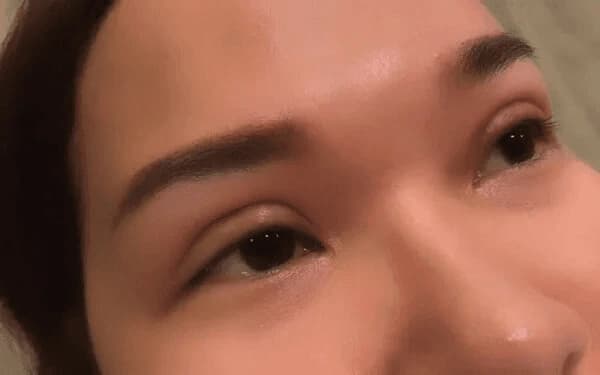 Nếu tình trạng cắt mí sau 1 tháng vẫn sưng không cải thiện, bạn nên đi khám càng sớm càng tốt