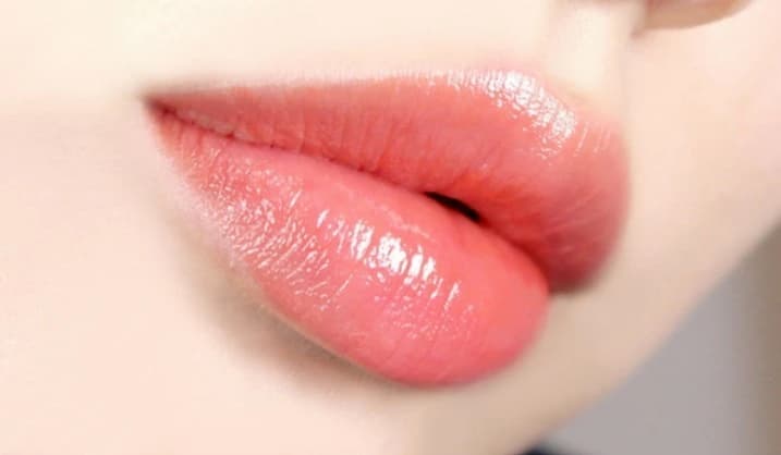 Đôi môi căng mọng tự nhiên sau khi cấy môi sinh học