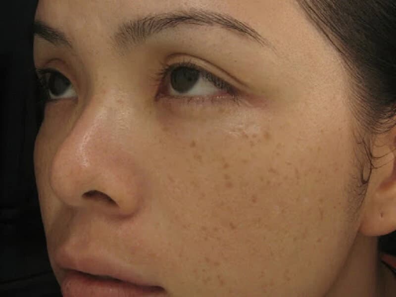Tìm hiểu các loại nám da: Nguyên nhân và cách điều trị