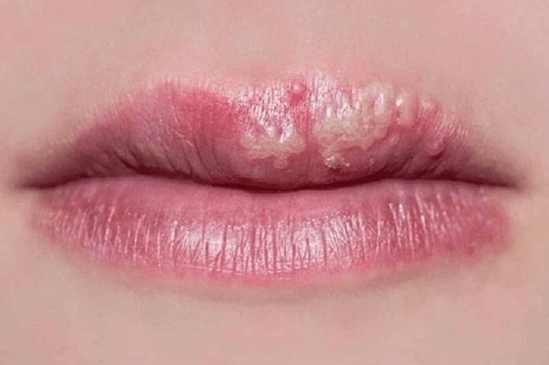 Hậu quả khó lường của phun môi giá rẻ, kém chất lượng