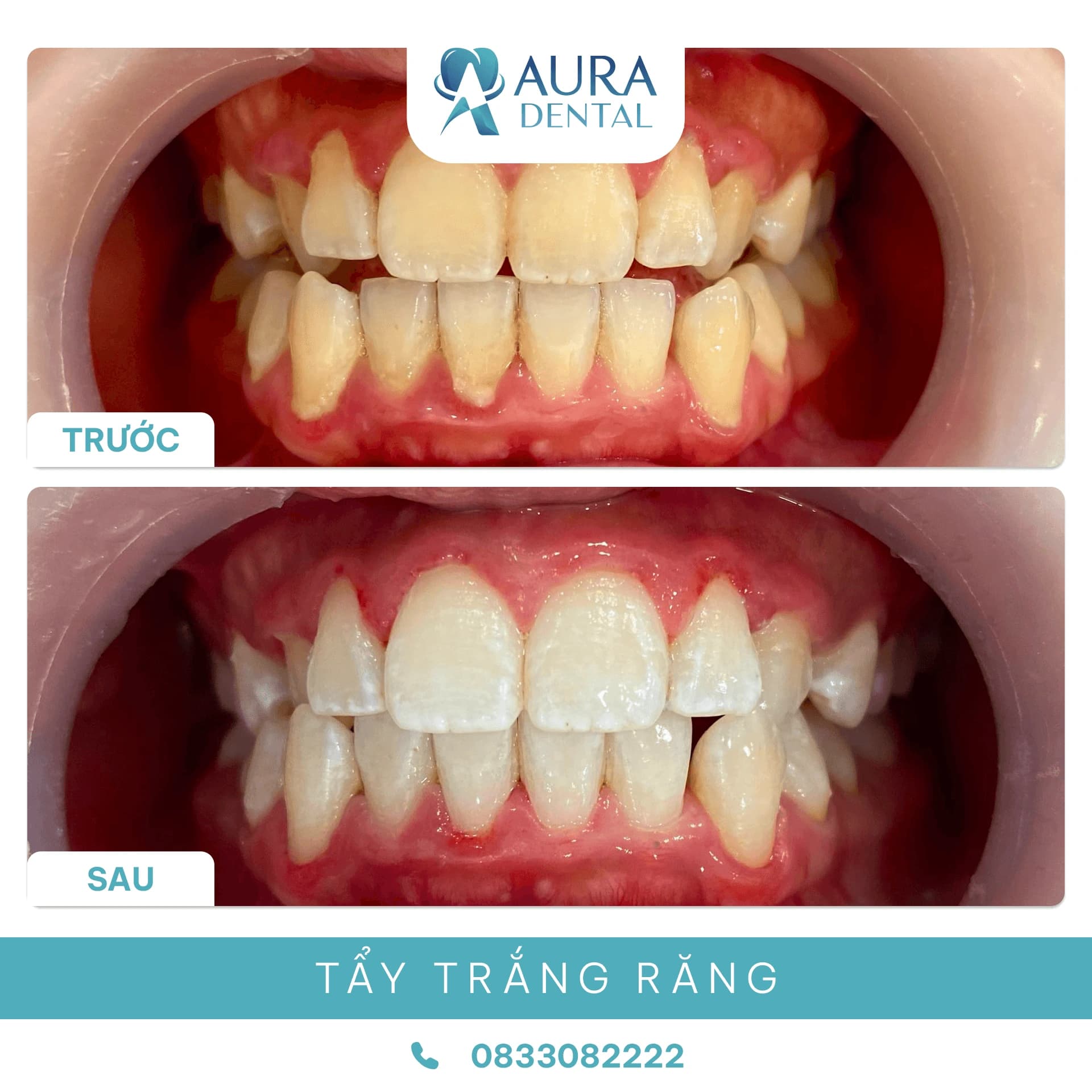 Tẩy trắng răng